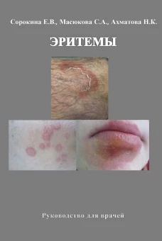 Эритемы. Руководство для врачей. Ахматова Н.К., Масюкова С.А., Сорокина Е.В.