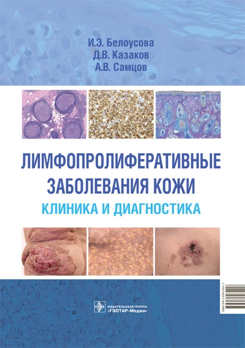 Лимфопролиферативные заболевания кожи. Клиника и диагностика. Белоусова И.Э., Самцов А.В., Казаков Д.В.