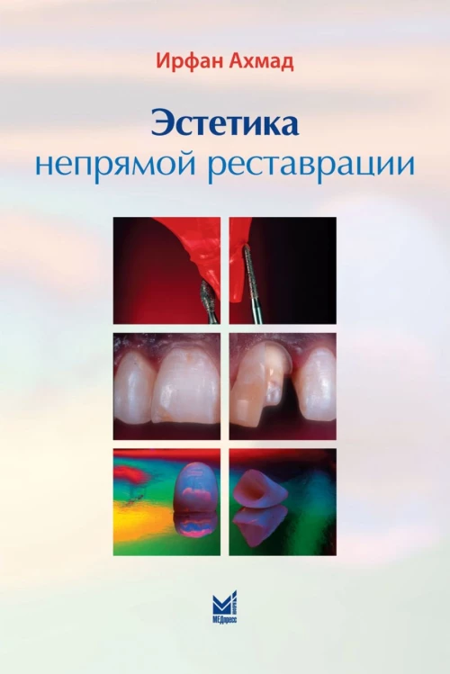 Эстетика непрямой реставрации